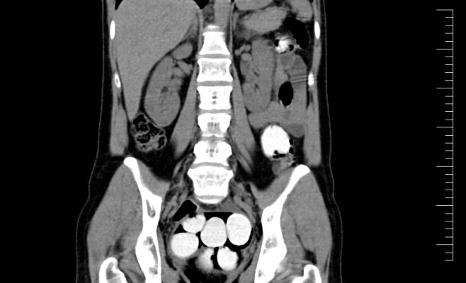 Иностранец пытался ввести в Чехию в своём теле 1,2 кг кокаина