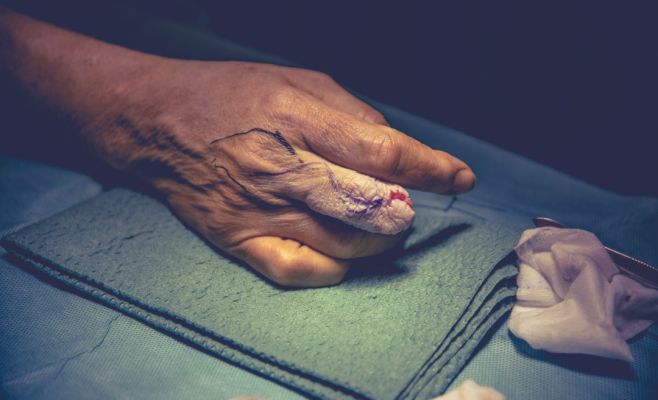 В Чехии проведена уникальная операция: женщине пересадили палец с ноги на руку