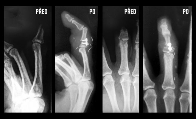 В Чехии проведена уникальная операция: женщине пересадили палец с ноги на руку