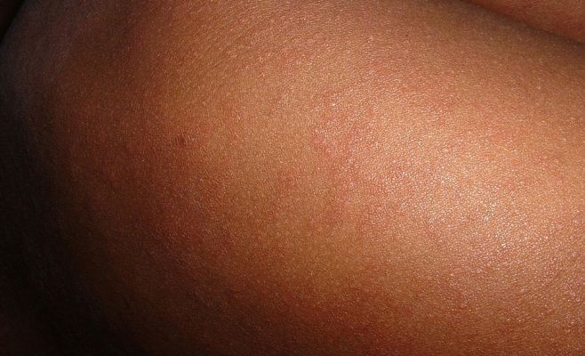 В Чехии распространяется вирус кори