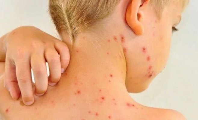 В Чехии новый скачок заболеваемости корью