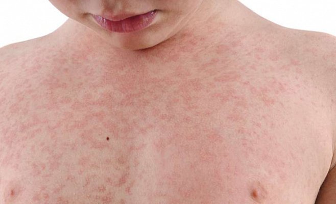 Министерство здравоохранения не планирует проводить обязательную вакцинацию взрослых от кори