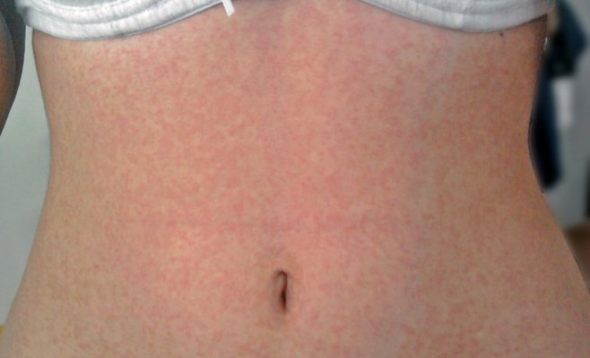 Эпидемия кори в Праге: число инфицированных достигло 135 человек