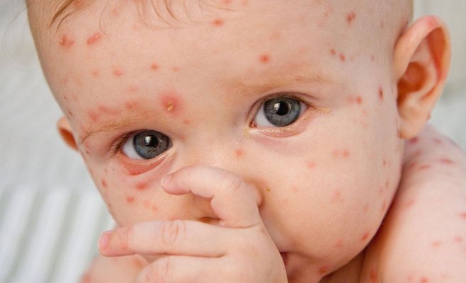 В Чешской Республике снова зафиксированы случаи заболевания корью