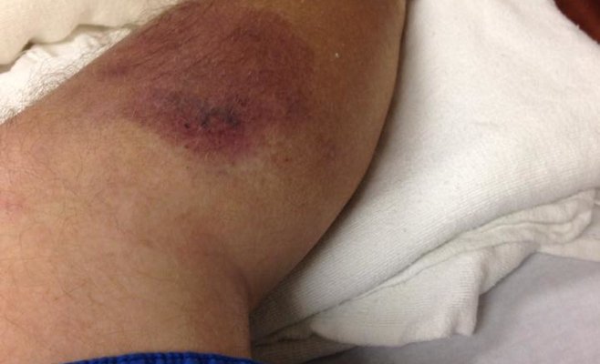 Врачам удалось спасти ногу мужчине, заразившемуся опасной бактерией в море Болгарии