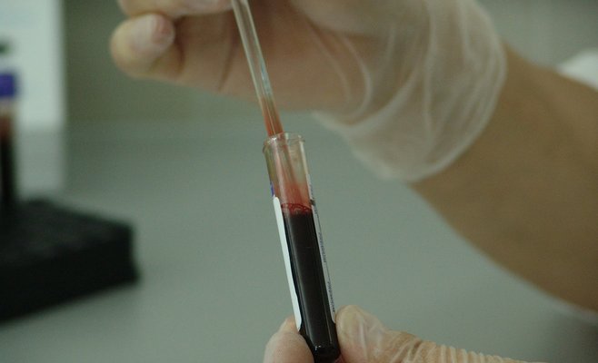 В Чехии началась Европейская неделя тестирования на ВИЧ – анонимно и бесплатно