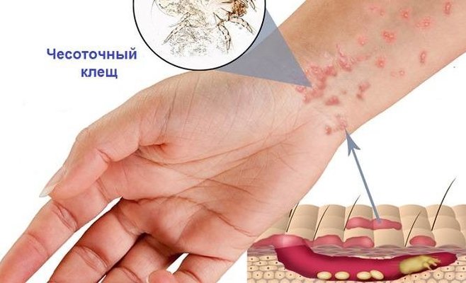В этом году в Чешской Республике наблюдается сильное распространение чесотки. Паразит не только неприятен, но и опасен