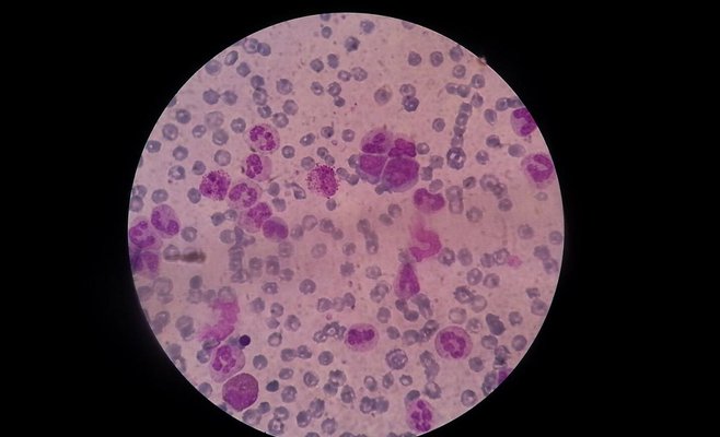 Чешские ученые обнаружили мутацию, связанную с лейкемией