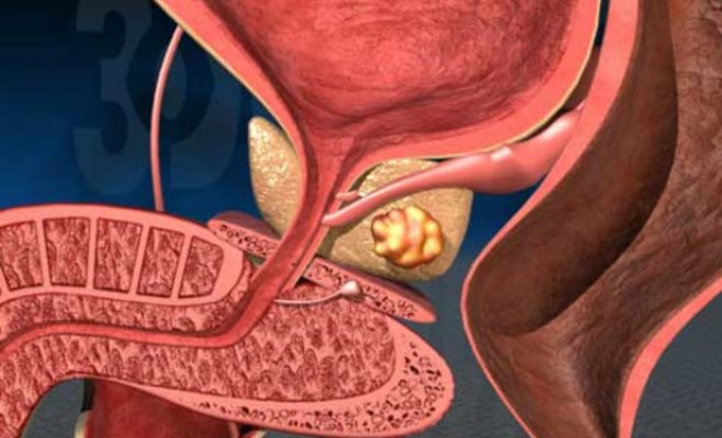 Число больных раком предстательной железы растет, мужчины старше 50 лет смогут пройти профилактический скрининг