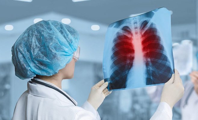 В Чехии участились случаи заболевания туберкулезом, половина пациентов - иностранцы