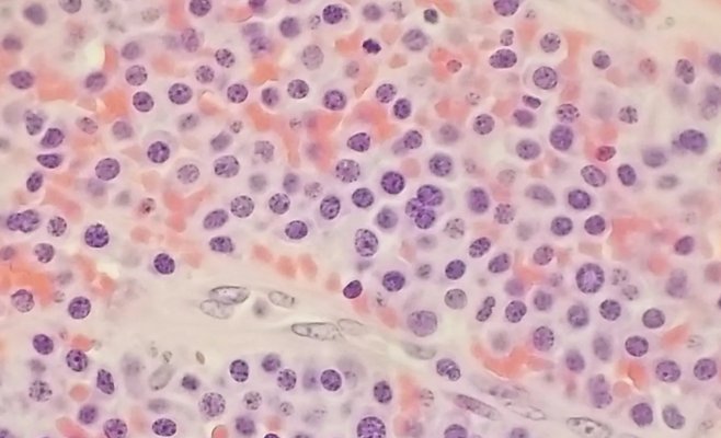 Казалось, будто что-то пожирает ее изнутри. Это была мультимиелома