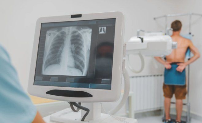 Врачи обнаружили начальную стадию рака легких у 100 человек. Благодаря скринингу