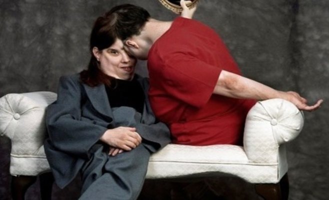 Самые старые сиамские близнецы умерли