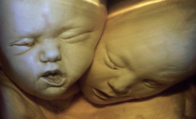 Самые старые сиамские близнецы умерли