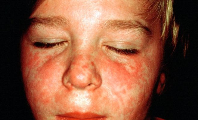 Европа страдает от кори: рост заболеваемости в Чехии