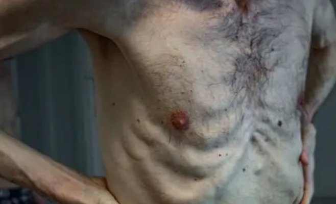 Два года в российском плену: украинец выглядит как узник концлагеря