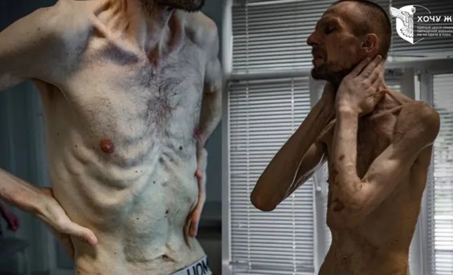 Два года в российском плену: украинец выглядит как узник концлагеря