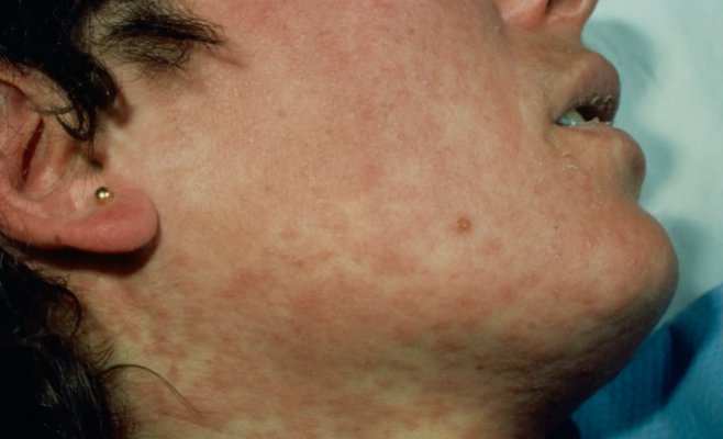 Число случаев кори растет: в Чехии десятки тысяч детей не привиты