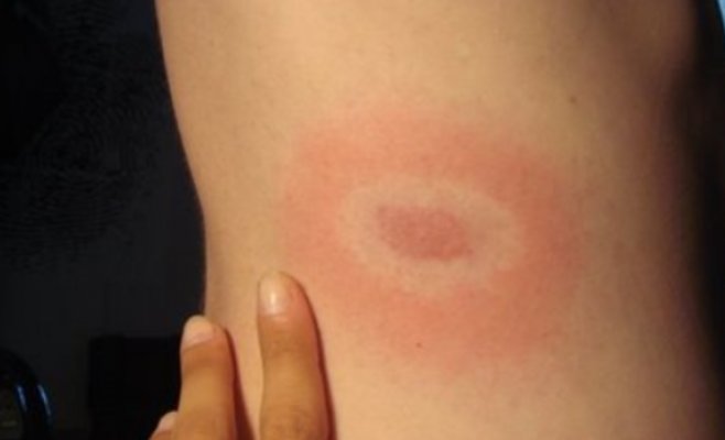 Опасная лихорадка денге: всё больше чехов возвращаются из поездок с опасной инфекцией