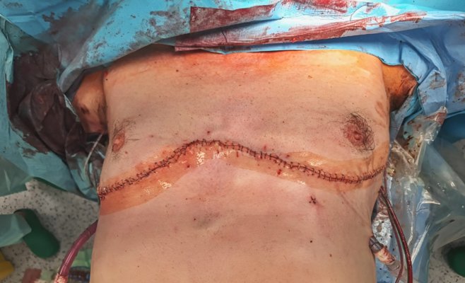 В Оломоуце спасли мужчину, которому металлический прут пробил обе легкие