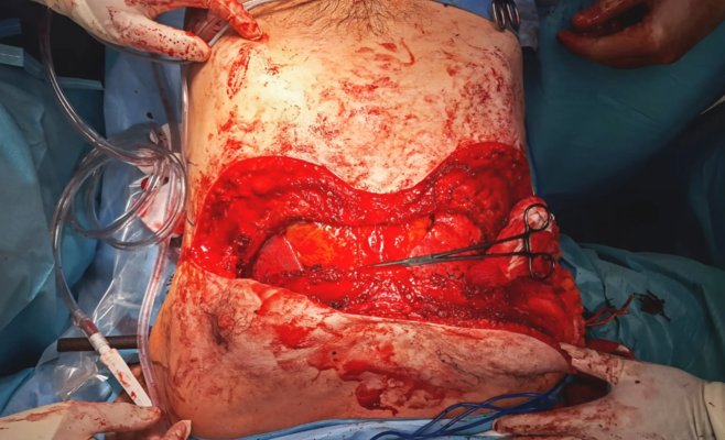 В Оломоуце спасли мужчину, которому металлический прут пробил обе легкие