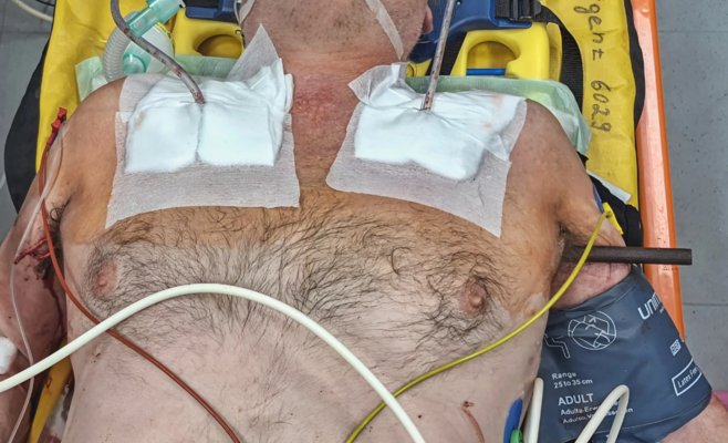 В Оломоуце спасли мужчину, которому металлический прут пробил обе легкие