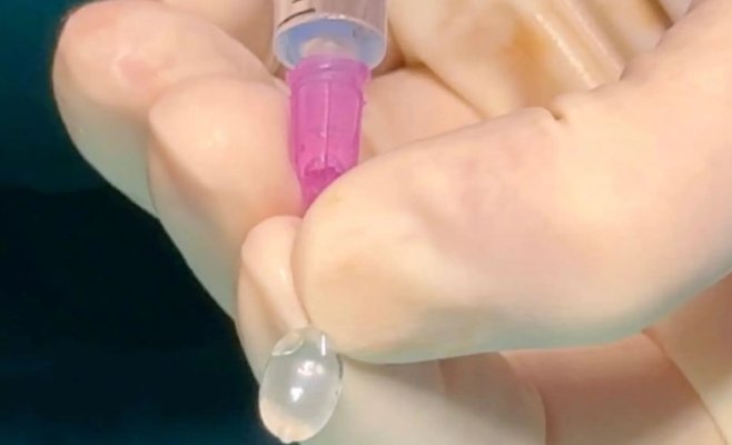 Врачи в Подоли провели операцию на плоде в утробе матери, внедрив «баллон» в дыхательные пути