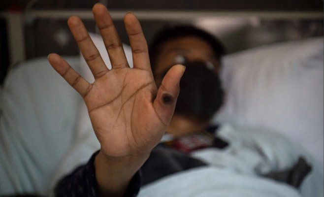 В Швеции зафиксирован случай вируса mpox: ВОЗ предупреждает об опасности