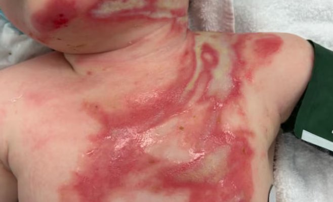 В Австралии мужчина специально вылил на ребенка горячий кофе: малыш получил серьезные ожоги