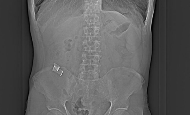 Мужчина требует 3 миллиона за ошибку врачей. Больница считает, что одного миллиона достаточно