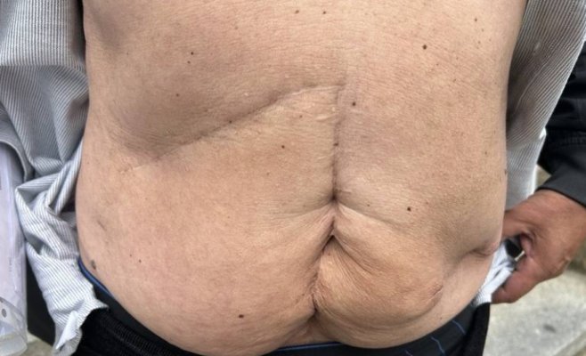 Мужчина требует 3 миллиона за ошибку врачей. Больница считает, что одного миллиона достаточно