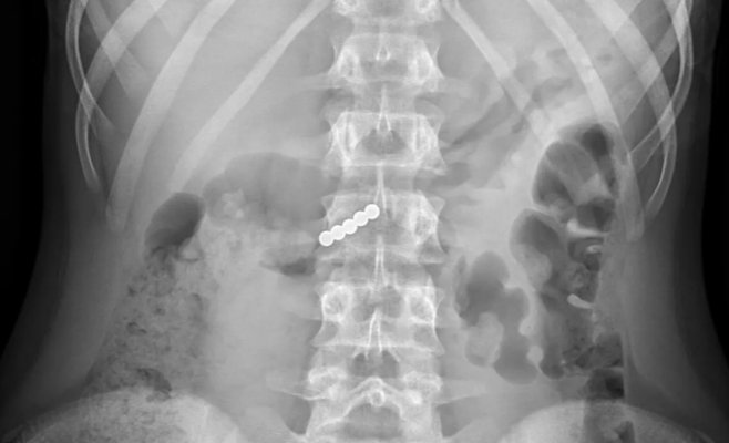 В больнице Мотола несколько детей оказались на операционном столе после опасного тренда с магнитами