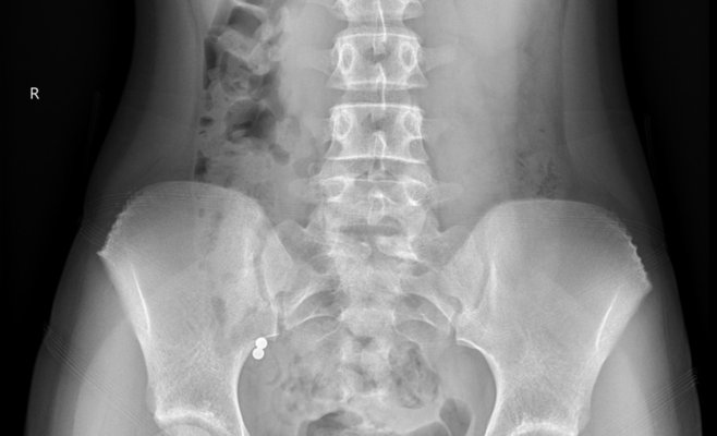 В больнице Мотола несколько детей оказались на операционном столе после опасного тренда с магнитами