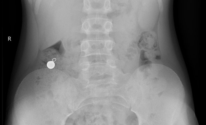 В больнице Мотола несколько детей оказались на операционном столе после опасного тренда с магнитами