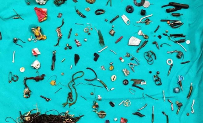 В желудке 15-летнего индийца нашли 56 металлических предметов — подросток умер после операции