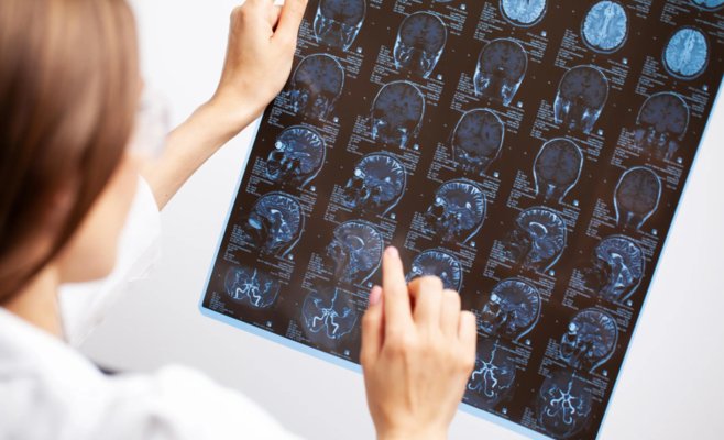 Прорыв в лечении Альцгеймера: новый препарат может помочь тысячам пациентов в Чехии