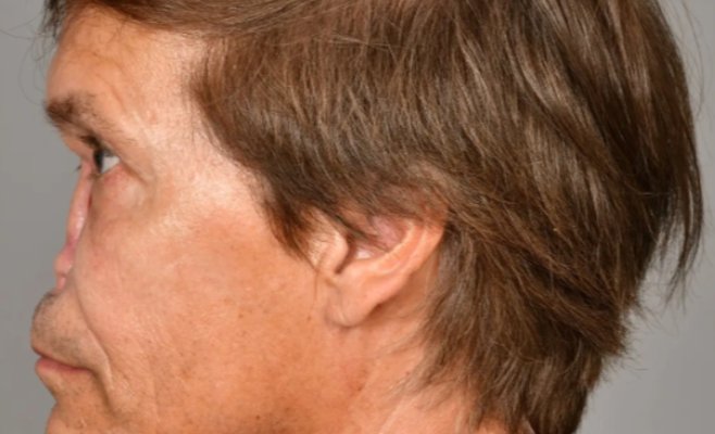 Мужчина потерял весь нос из-за рака, а в голове осталась дыра. Врачи в Брно создали ему новый