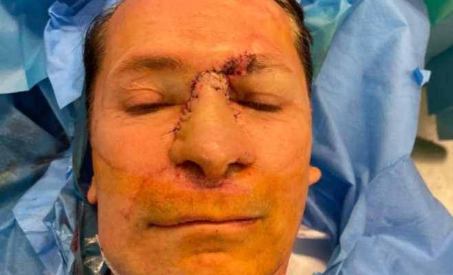 Мужчина потерял весь нос из-за рака, а в голове осталась дыра. Врачи в Брно создали ему новый