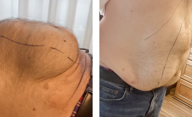 Не мог избавиться от грыжи — помог уникальный щадящий метод. Но сначала пришлось похудеть