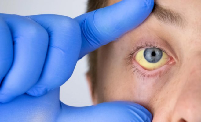 Случаев гепатита А в Чехии в этом году больше всего за 41 год, умерли уже 31 человек