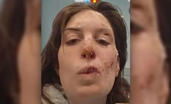 Невыносимая боль и ежедневная борьба. Элеонора выжила после пожара в швейцарском баре