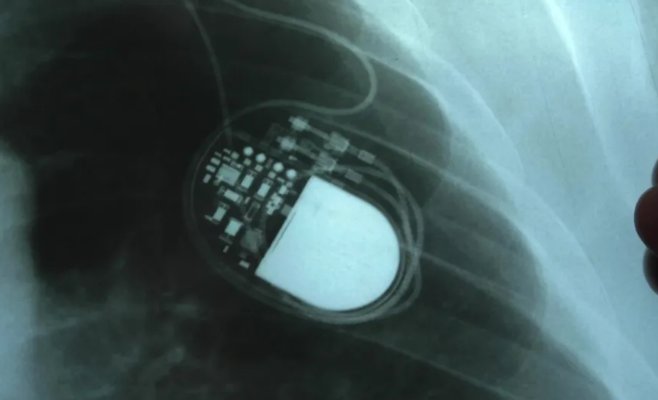 Будущим пенсионерам готовят новое замедление роста пенсий: чем позже выход на пенсию, тем ощутимее снижение