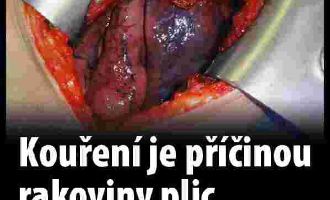 В Чехии будут продавать пачки сигарет с пугающими картинками