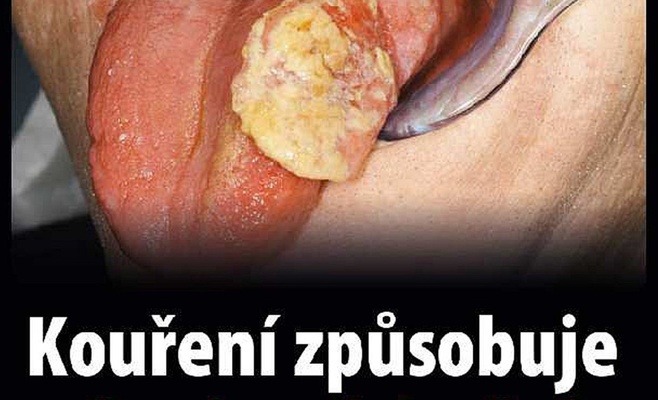 В Чехии будут продавать пачки сигарет с пугающими картинками