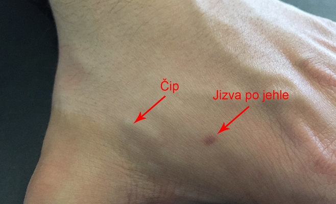 В Чехии начали людям вживлять чипы в тело